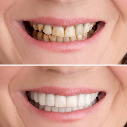 SMILEPRO® – Carillas para Dientes | Oferta 2 por 1
